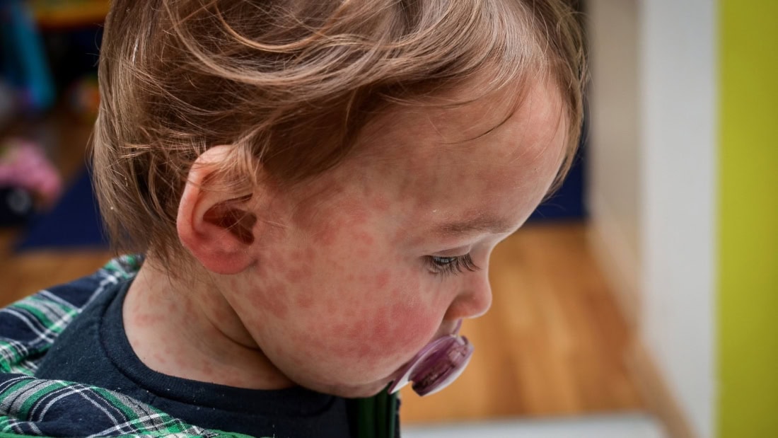 Skin rash and fever in a child with measles, symptoms and treatment.